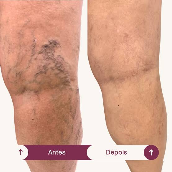 Resultado real 1